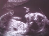 20th week ultrasound